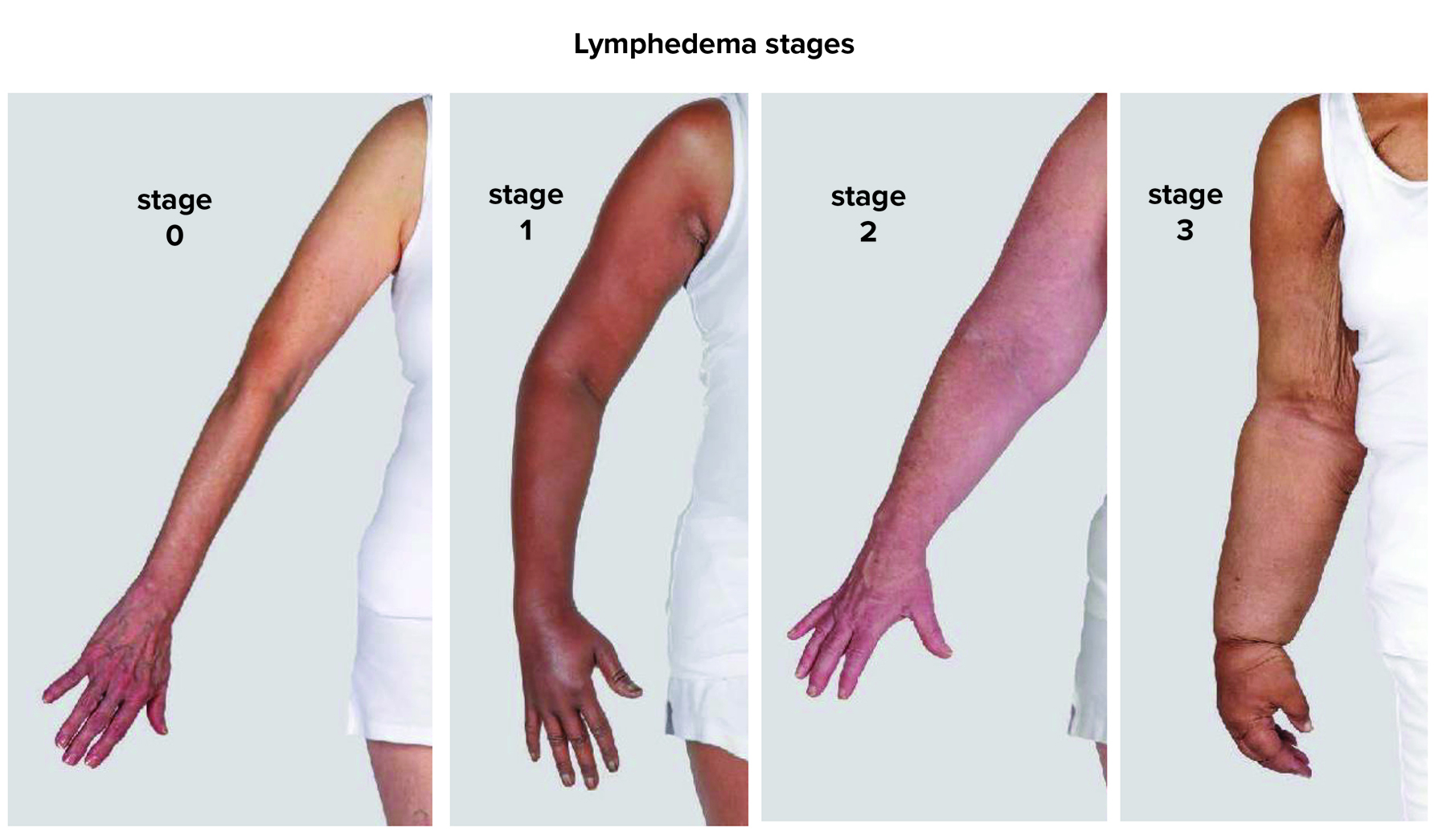 Lymphewhat? One woman’s story of a side effect of breast cancer